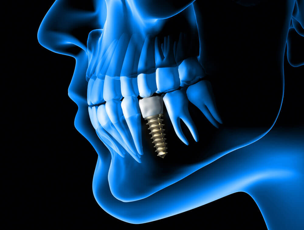 Vitamin D Deficiency Dental Implant Failure iSmile
